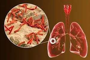 آشنایی با بیماری سل و راههای تشخیص آن